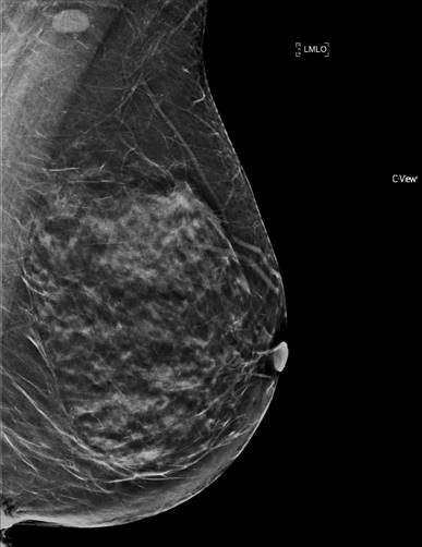 Standard reconstructed 2D mammogram views that are obtained from a digital breast tomosynthesis.