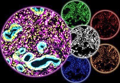 Human pancreatic cancer pathological sample showing a pro-tumor desmoplastic phenotype. Image adapted from Alexander & Cukierman Matrix Biology 2020 and depicts central discoveries included in Franco-Barraza et al eLife 2017. Image credit Neelima Shah and Edna Cukierman