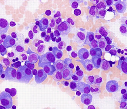 Multiple myeloma, photo courtesy of the American Society of Hematology (ASH)