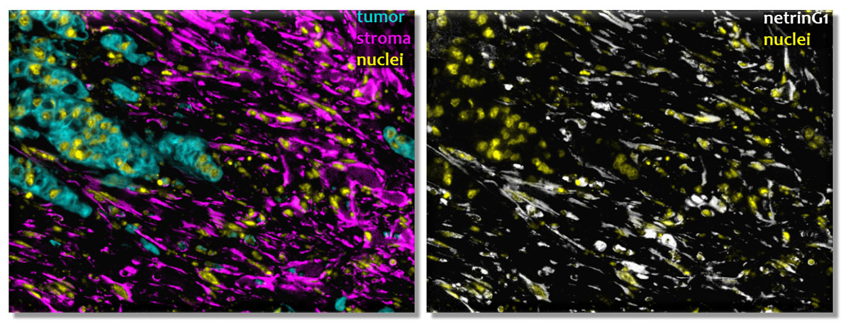 Images showing cancer cells (cyan), fibroblastic stroma (magenta), nuclei (yellow), and NetG1 (white), which is highly expressed in fibroblastic stromal areas. (Image Courtesy of Neelima Shah)