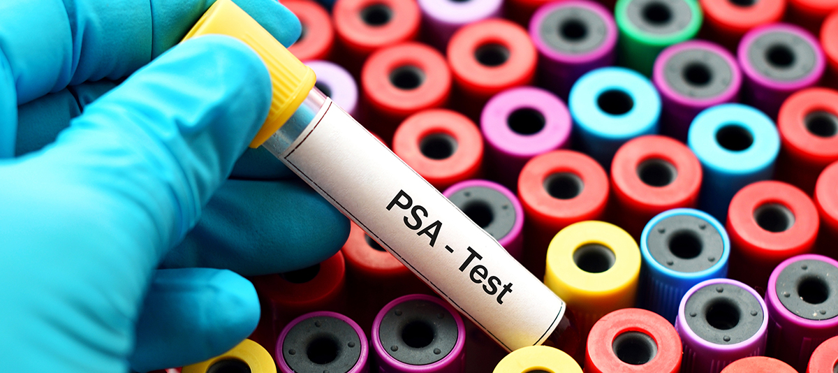 A photograph of dozens of upright vials with different colored lids, a gloved hand above it holds one that reads, "PSA - Test."