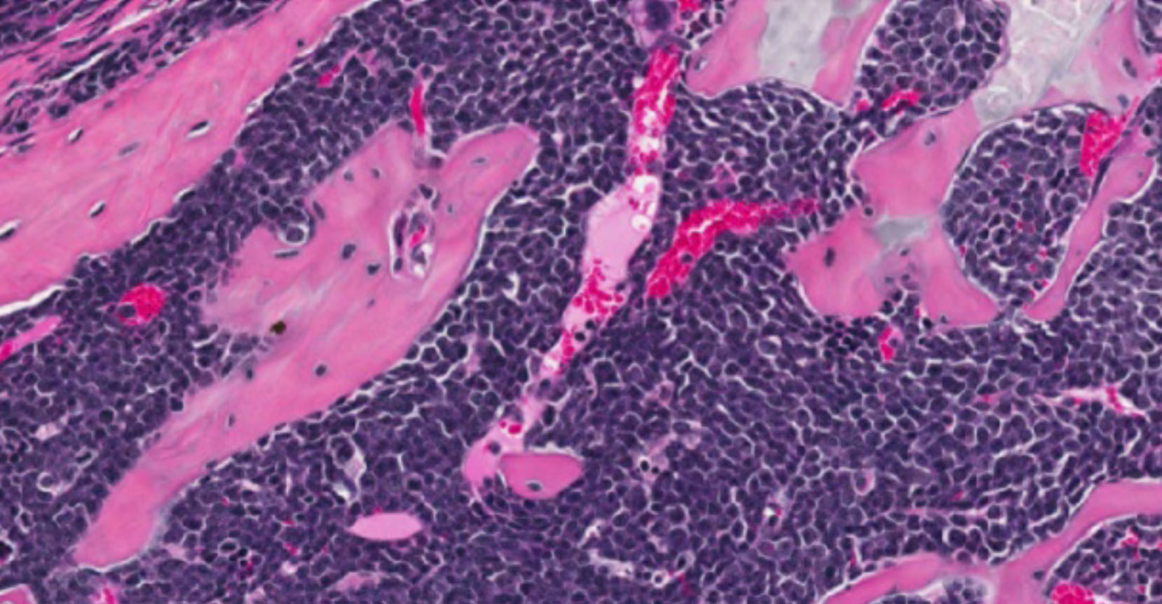 This figure shows dissemination of malignant T-ALL cells to the bone marrow of a Dlx5;Akt2 mouse that had aggressive disease that had spread to multiple organs. (Image Courtesy of Joseph R. Testa, PhD)