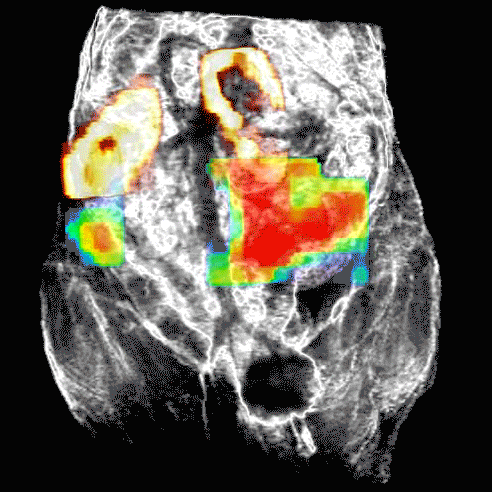 Combined FMT and MRI of ovarian tumors in mice.