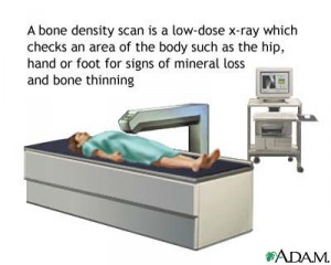 A drawing of a person lying under a bone density scanner, a low dose x-ray that checks for mineral loss or bone thinning.