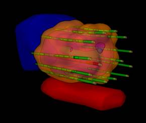 3D view of an HDR prostate implant.