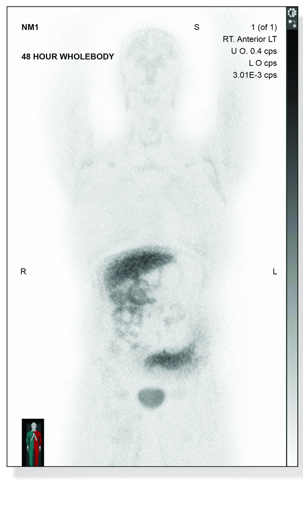 The old method, an octreotide PET scan