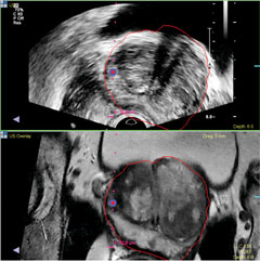 Two black and white MRI images stacked on top of each other, highlighting a problematic area.