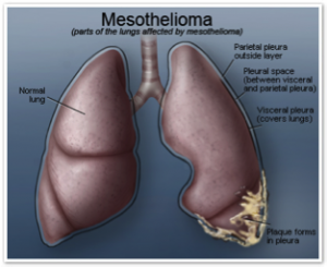 A drawing of a set of human lungs with the bottom right side covered in webs of plaque, depicting mesothelioma.