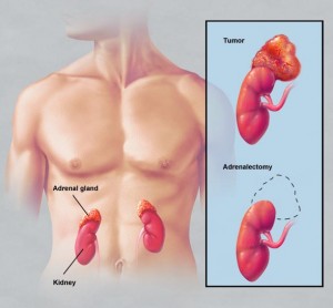 For patients requiring the removal of the adrenal glands, minimally invasive laparoscopic and robotic surgery are viable options. Our surgical experts are also comfortable with adrenal tissue preservation strategies and open surgical techniques when necessary.