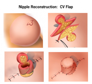 A diagram showing the process of reconstructing a nipple using the CV Flap technique.