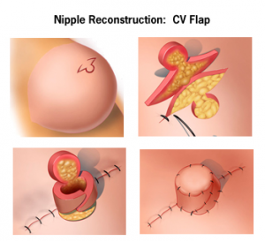 Nipple Reconstruction