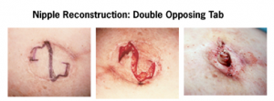 A diagram showing the process of reconstructing a nipple using the Double Opposing Tab technique.