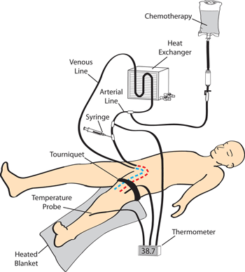 A tourniquet is used to stop the blood circulation in the affected limb. A catheter is inserted into both the artery and vein and used to circulate a high dose of the treatment drug into the limb without the stress on other organs that would normally occur.
