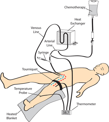 Isolated Limb Infusion