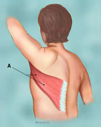 Latissimus dorsi muscle Courtesy of breastcancer.org