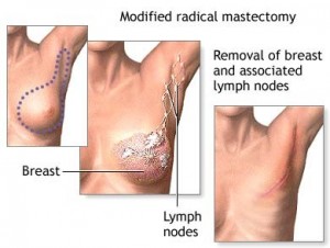 A collage of drawings showing where the incision would be in a modified radical mastectomy, the breast and surrounding lymph nodes removed, and the final result.