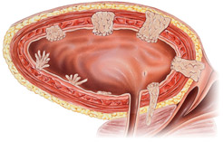 muscle-invasive-bladder-cancer