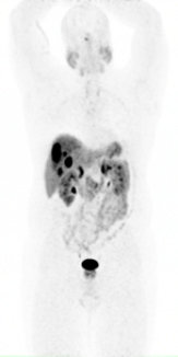 Gallium68 PET scan 