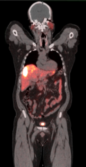 PET and CT images merged