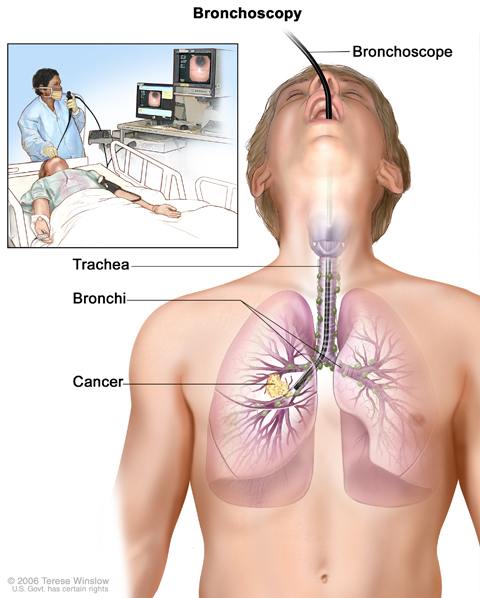  Bronchoscopy. A bronchoscope is inserted through the mouth, trachea, and major bronchi into the lung, to look for abnormal areas. A bronchoscope is a thin, tube-like instrument with a light and a lens for viewing. It may also have a cutting tool. Tissue samples may be taken to be checked under a microscope for signs of disease.