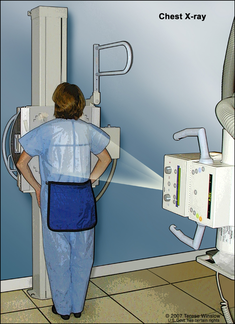 X-ray of the chest. X-rays are used to take pictures of organs and bones of the chest. X-rays pass through the patient onto film. 