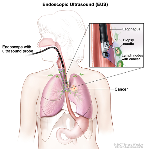 Endoscopic ultrasound-guided fine-needle aspiration biopsy. An endoscope that has an ultrasound probe and a biopsy needle is inserted through the mouth and into the esophagus. The probe bounces sound waves off body tissues to make echoes that form a sonogram (computer picture) of the lymph nodes near the esophagus. The sonogram helps the doctor see where to place the biopsy needle to remove tissue from the lymph nodes. This tissue is checked under a microscope for signs of cancer.