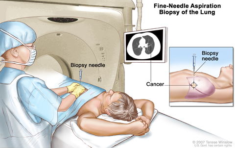Fine-needle aspiration biopsy of the lung. The patient lies on a table that slides through the computed tomography (CT) machine, which takes x-ray pictures of the inside of the body. The x-ray pictures help the doctor see where the abnormal tissue is in the lung. A biopsy needle is inserted through the chest wall and into the area of abnormal lung tissue. A small piece of tissue is removed through the needle and checked under the microscope for signs of cancer.