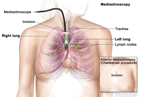 Mediastinoscopy. A mediastinoscope is inserted into the chest through an incision above the breastbone to look for abnormal areas between the lungs. A mediastinoscope is a thin, tube-like instrument with a light and a lens for viewing. It may also have a cutting tool. Tissue samples may be taken from lymph nodes on the right side of the chest and checked under a microscope for signs of cancer. In an anterior mediastinotomy (Chamberlain procedure), the incision is made beside the breastbone to remove tissue 