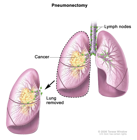 Pneumonectomy. The whole lung is removed.