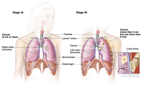 Stage I non-small cell lung cancer. In stage IA, cancer is in the lung only and is 3 cm or smaller. In stage IB, the cancer is (a) larger than 3 cm but not larger than 5 cm, (b) has spread to the main bronchus, and/or (c) has spread to the innermost layer of the lung lining. Part of the lung may have collapsed or become inflamed (not shown).