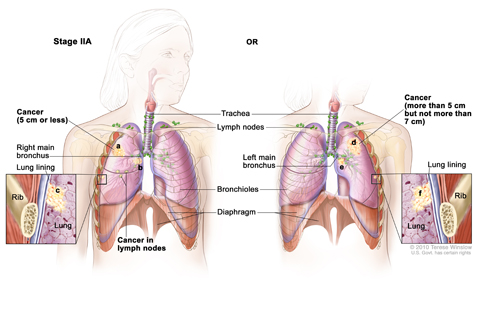 Stage IIA non-small cell lung cancer. Cancer has spread to certain lymph nodes on the same side of the chest as the primary tumor; the cancer is (a) 5 cm or smaller, (b) has spread to the main bronchus, and/or (c) has spread to the innermost layer of the lung lining. OR, cancer has not spread to lymph nodes; the cancer is (d) larger than 5 cm but not larger than 7 cm, (e) has spread to the main bronchus, and/or (f) has spread to the innermost layer of the lung lining. Part of the lung may have collapsed or 