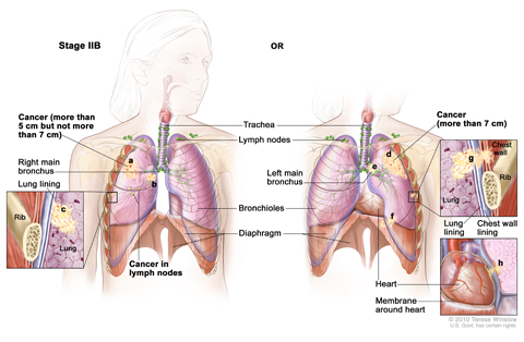 Stage IIB non-small cell lung cancer. Cancer has spread to certain lymph nodes on the same side of the chest as the primary tumor; the cancer is (a) larger than 5 cm but not larger than 7 cm, (b) has spread to the main bronchus, and/or (c) has spread to the innermost layer of the lung lining. Part of the lung may have collapsed or become inflamed (not shown). OR, (d) the cancer is larger than 7 cm; (e) has spread to the main bronchus, (f) the diaphragm, (g) the chest wall or the lining of the chest wall; an
