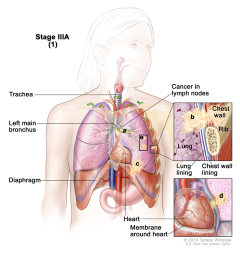 Stage IIIA non-small cell lung cancer (1). Cancer has spread to certain lymph nodes on the same side of the chest as the primary tumor. The cancer may have spread to (a) the main bronchus; (b) lung lining, chest wall lining, or chest wall; (c) diaphragm; and/or (d) membrane around the heart; and/or (e) there may be one or more separate tumors in the same lobe of the lung. Cancer may have spread to the nerve that controls the diaphragm, and part or all of the lung may have collapsed or become inflamed (not s