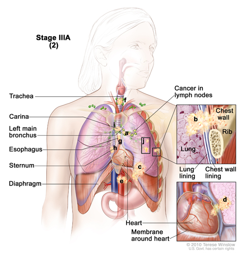 Cancer has spread to certain lymph nodes on the same side of the chest as the primary tumor. The cancer may have spread to (a) the main bronchus; (b) the lung lining, chest wall lining, or chest wall; (c) diaphragm; (d) heart and/or membrane around the it; (e) major blood vessels that lead to or from the heart; (f) trachea; (g) esophagus; (h) sternum; and/or (i) carina; and/or (j) there may be one or more separate tumors in any lobe of the same lung. Cancer may have spread to the nerves that control the dia