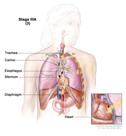 Stage IIIA non-small cell lung cancer (3). Cancer has spread to (a) the heart; (b) major blood vessels that lead to or from the heart; (c) trachea; (d) esophagus; (e) sternum; and/or (f) carina. Cancer may have spread to the nerve that controls the larynx (not shown).