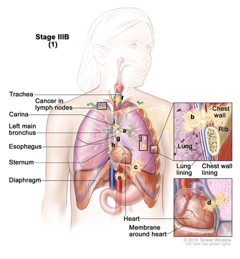 Stage IIIB non-small cell lung cancer (1). Cancer has spread to lymph nodes above the collarbone or on the opposite side of the chest as the primary tumor. The cancer may have spread to (a) the main bronchus; (b) lung lining, chest wall lining, or chest wall; (c) diaphragm; (d) heart or the membrane around it; (e) major blood vessels that lead to or from the heart; (f) trachea; (g) esophagus; (h) sternum; and/or (i) carina; and/or (j) there may be one or more separate tumors in any of the lobes of the lung.