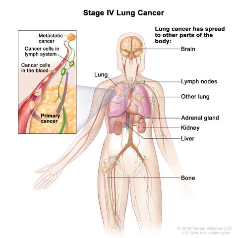Stage IV non-small cell lung cancer. The cancer has spread to the other lung, and/or to lymph nodes, fluid around the lungs or heart, and/or other parts of the body, such as the brain, liver, adrenal gland, kidney, or bone.