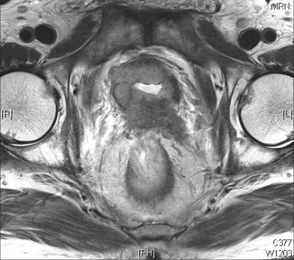 A black and white MRI photo of a malignant lesion of the prostate, from the National Institutes of Health.