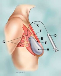 Side view of breast area with filled tissue expander in place labels: A: tissue expander–filled, B: port C: catheter, D: syringe, E: ribs F; pectoralis major muscle G: Other muscles of the chest wall  (3 lines to one letter) Courtesy of breastcancer.org