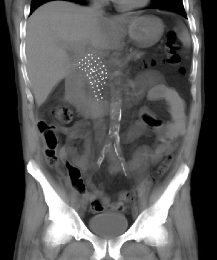 Post procedure CT scan performed at 2.5 weeks