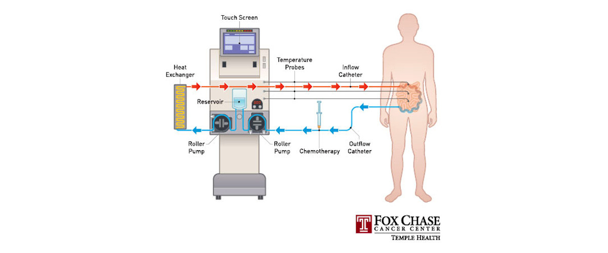 Following the surgical removal of visible tumors in the abdomen (debulking), the abdominal cavity is bathed with a heated chemotherapy solution for up to ninety minutes in the operating room. The abdominal cavity is bathed with a heated chemotherapy solution for up to ninety minutes in the operating room.