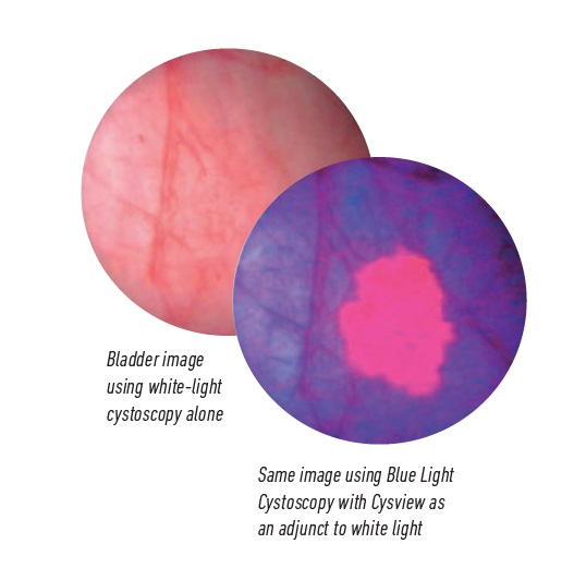 A side by side comparison of a bladder cystoscopy image with white light alone, and one using blue light with Cysview to assist.