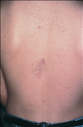 A closeup photo of a person's back, showing a palm sized purple dermatofibrosarcoma protuberan in the center of it.