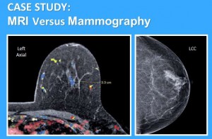 A side-by-side comparison of an MRI and a mammogram of a breast.