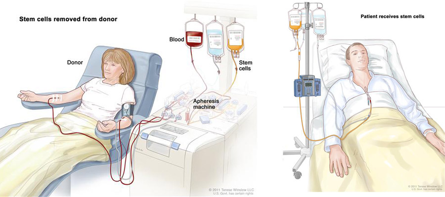 bone marrow transplant procedure