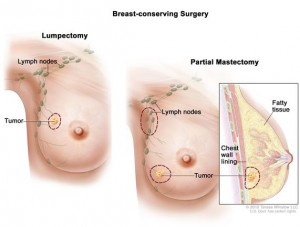 A side by side diagram comparison of two breast conserving surgeries: a lumpectomy and a partial mastectomy.