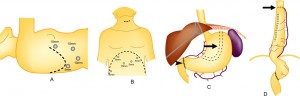 A diagram showing the steps associated with an esophagectomy.