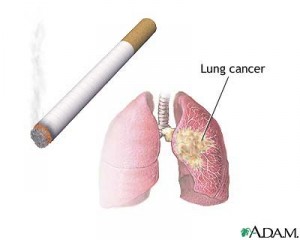 A drawing of a pair of lungs with a tan splotch on it labelled as lung cancer, and a lit cigarette drawn next to it.