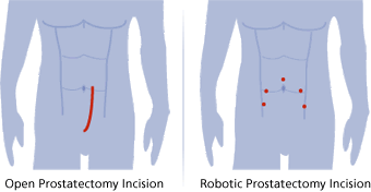 A diagram showing the incision difference between an open and robotic prostatectomy, with the open one being much larger.