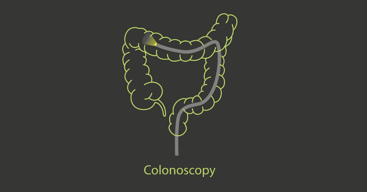 A linework drawing of a colon and a flashlight going all the way through it, with the word "Colonoscopy" written underneath.